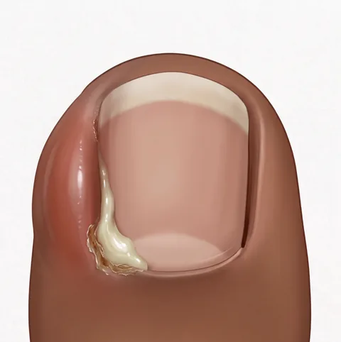 Illustration of an infected ingrown toenail: thick white and yellow pus discharges from the groove at the left side of the nail, with redness spreading onto the surrounding skin.